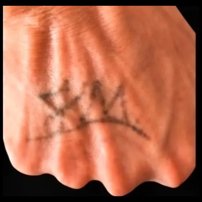 A mesma tatuagem na mão já mais clara, durante o tratamento
