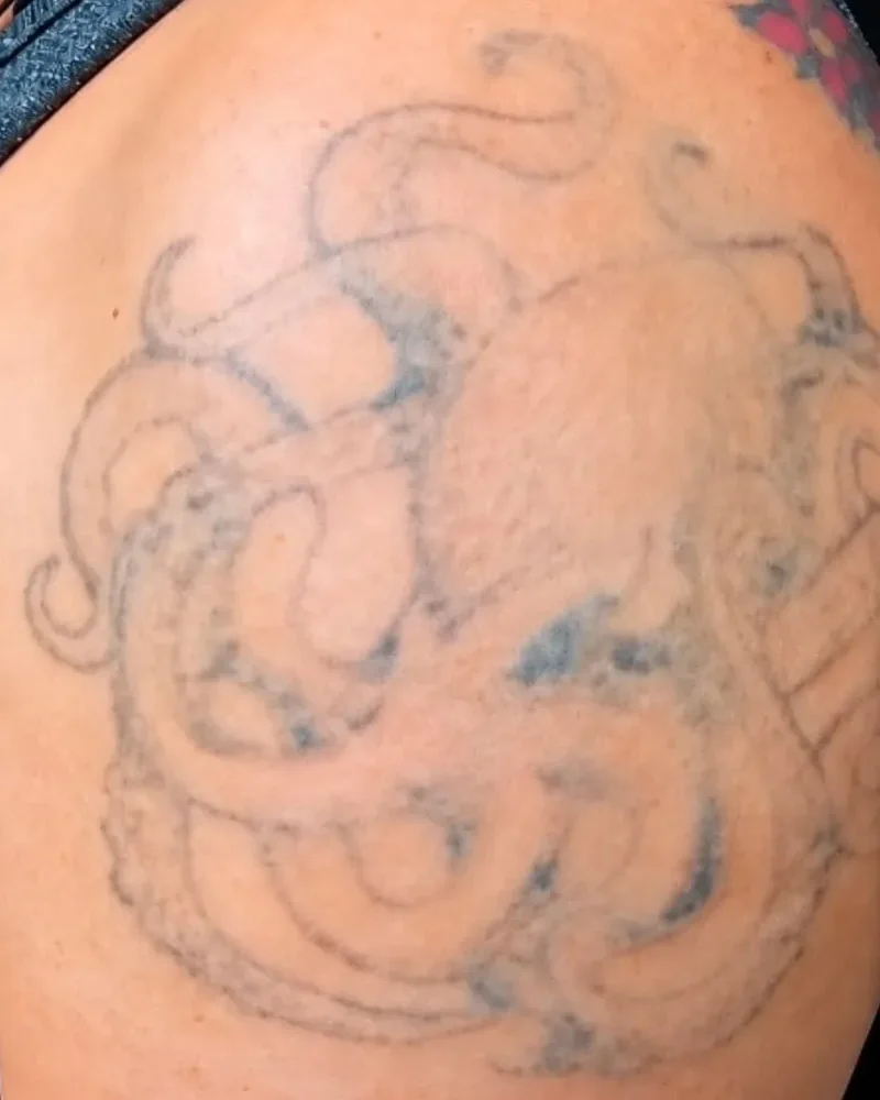 Tatuagem de polvo no ombro bem clareada após duas sessões de laser